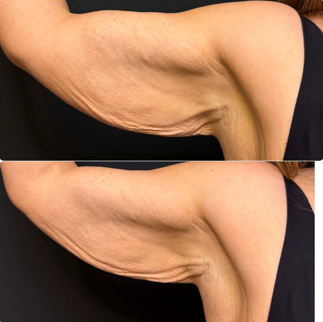 HIFU Body Lift — example 1