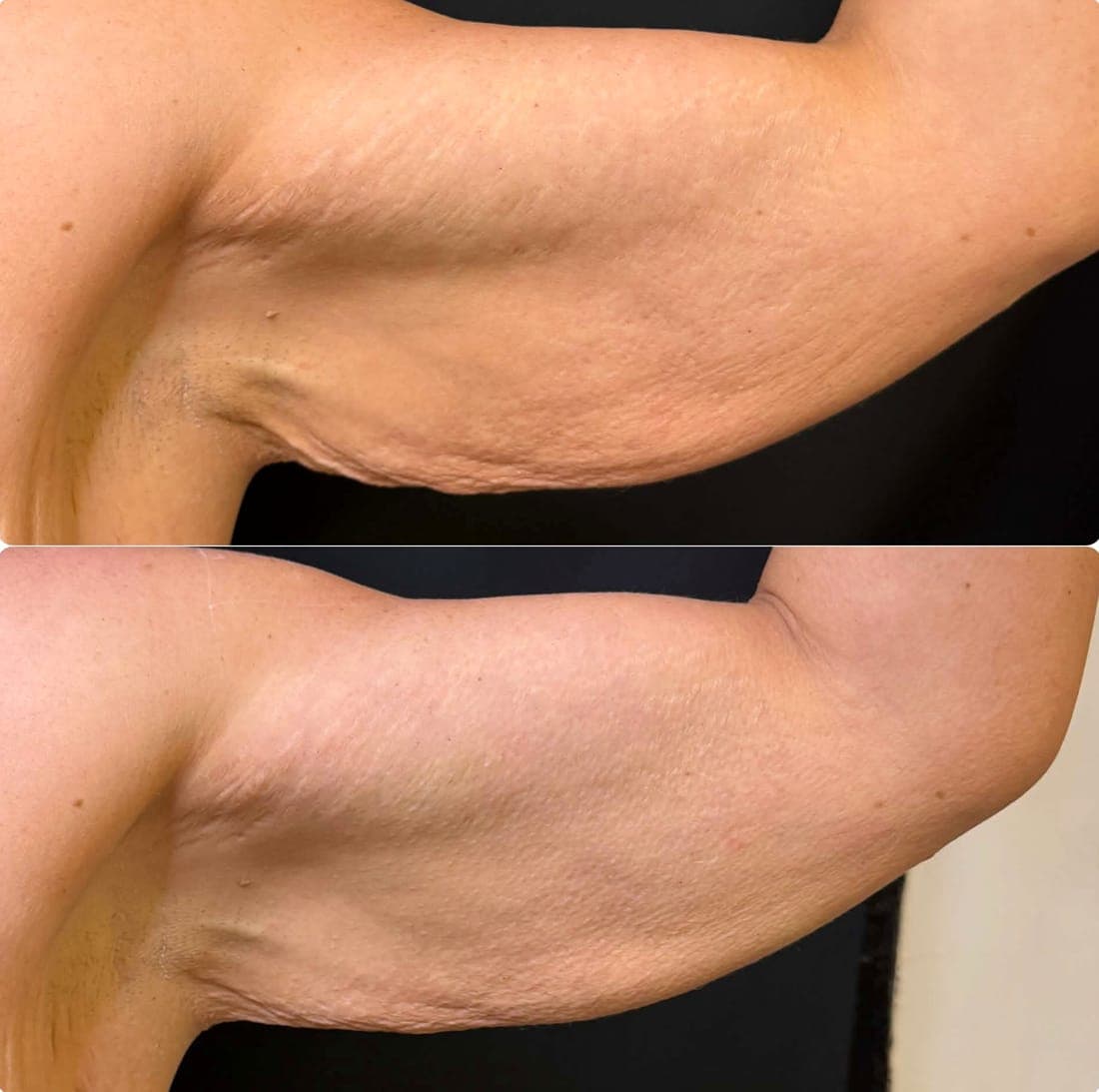 HIFU Body Lift — example 2