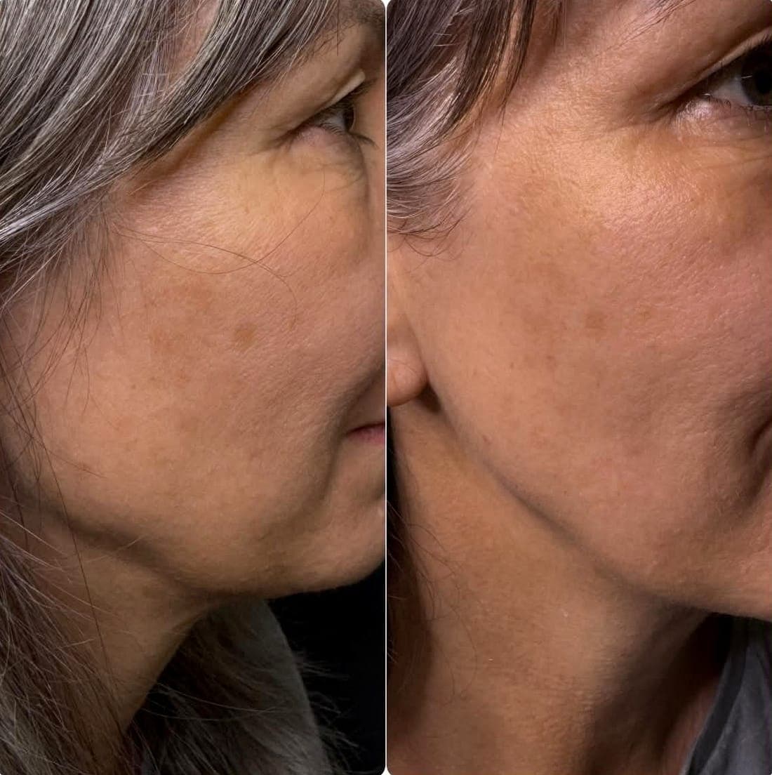 HIFU Face Lift — example 1