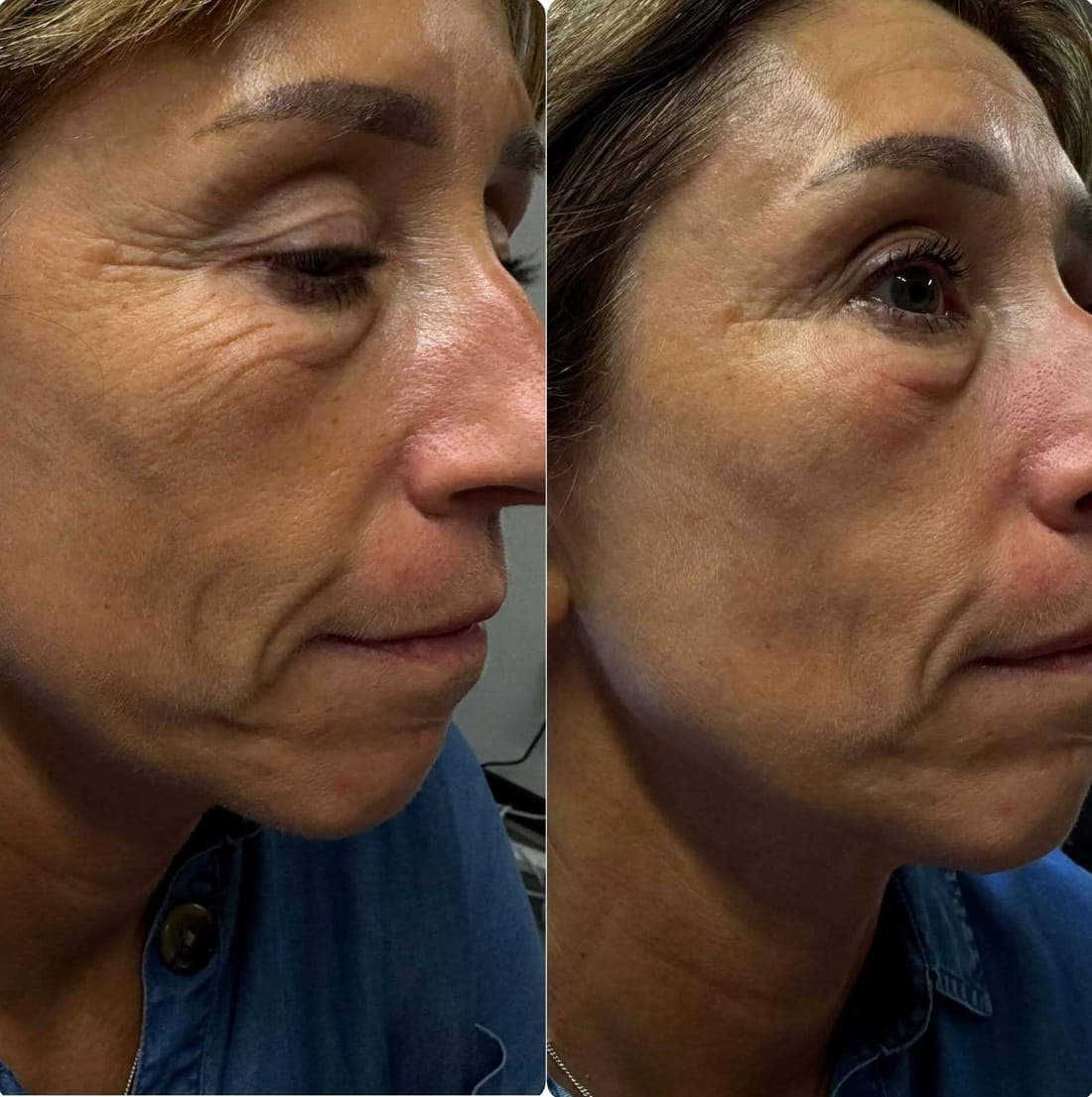HIFU Face Lift — example 2