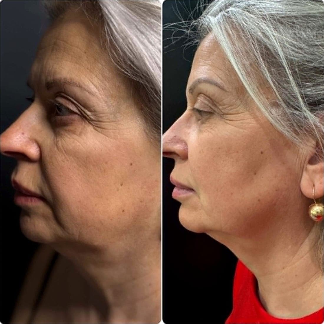 HIFU Face Lift — example 3