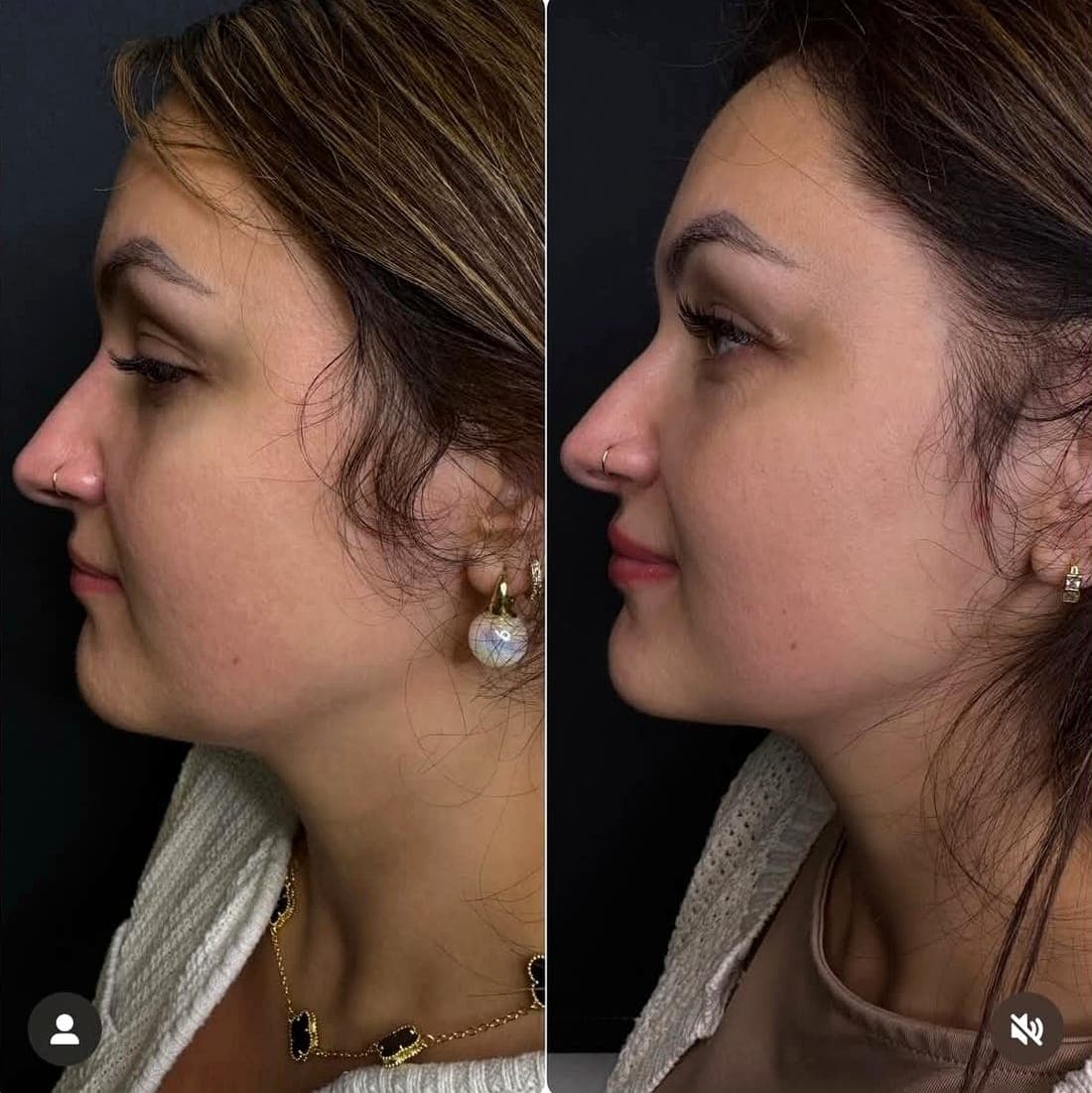 HIFU Face Lift — example 4