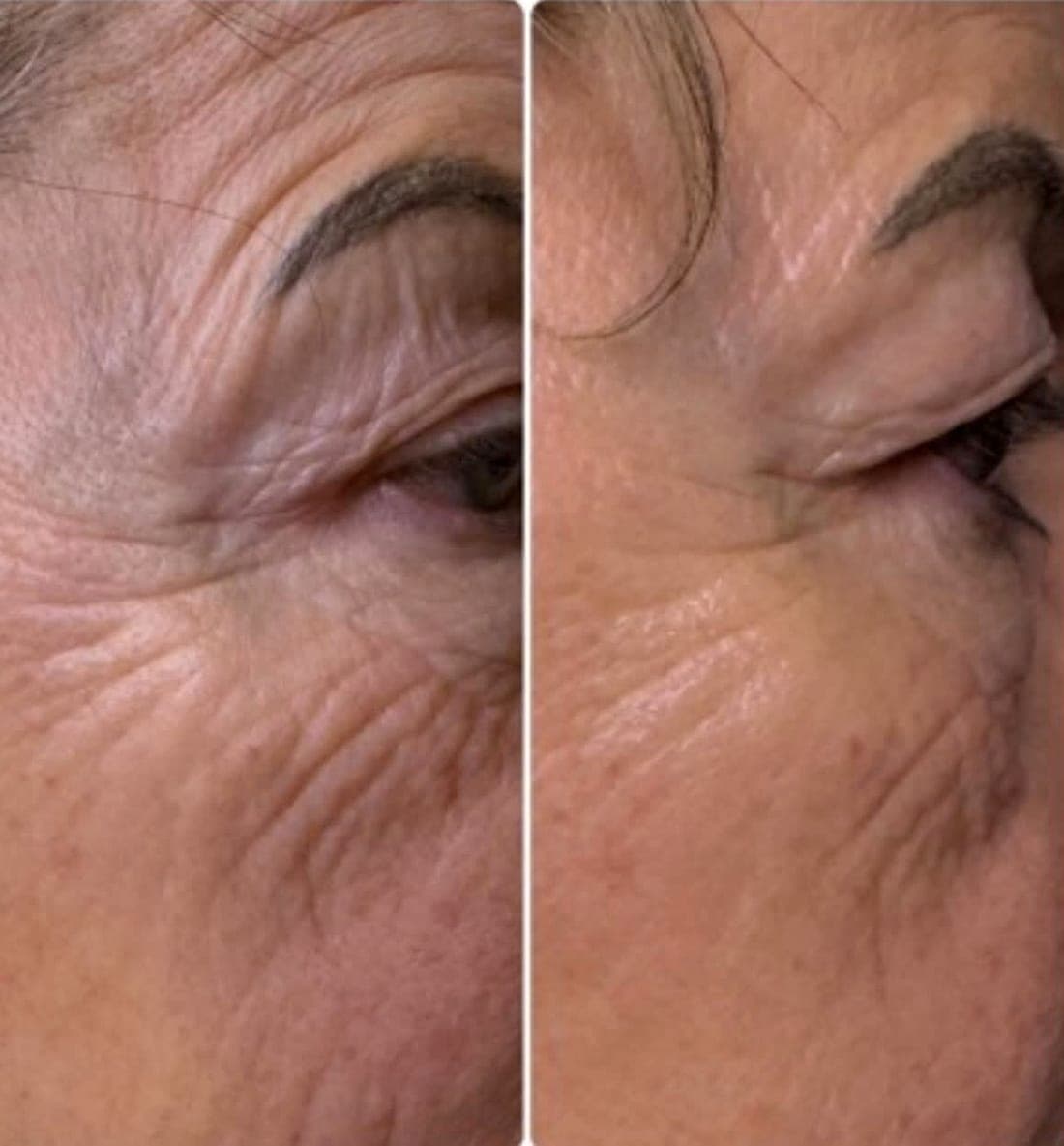 HIFU Face Lift — example 5