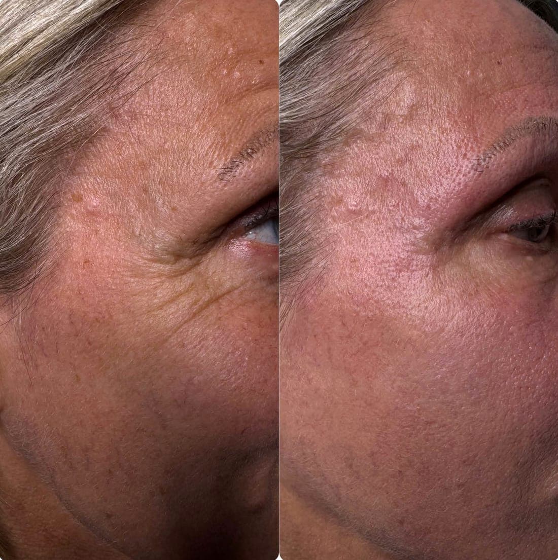 HIFU Face Lift — example 6
