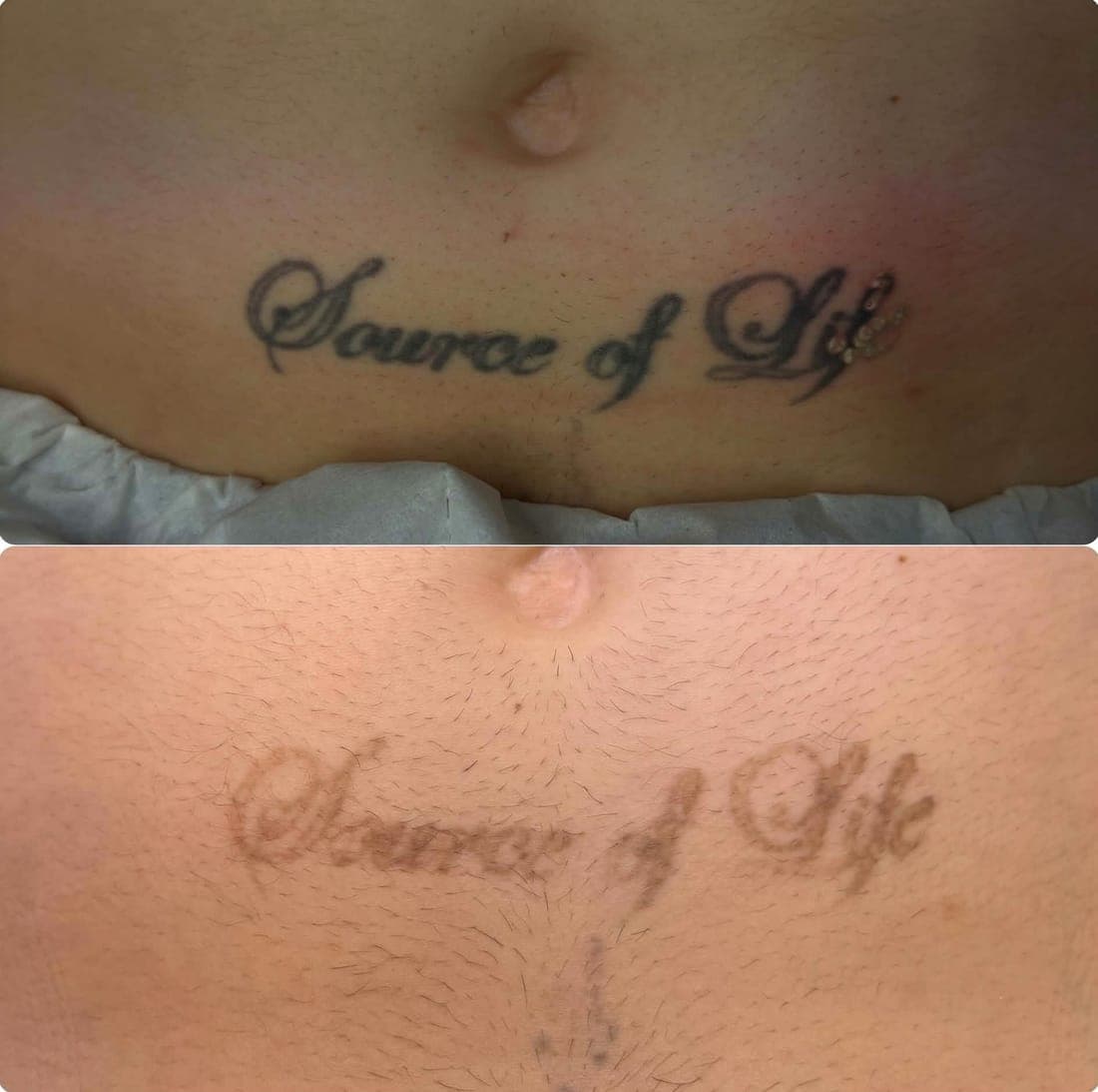 Laser Tattoo Removal — example 1