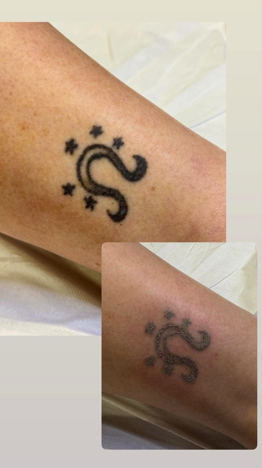 Laser Tattoo Removal — example 2
