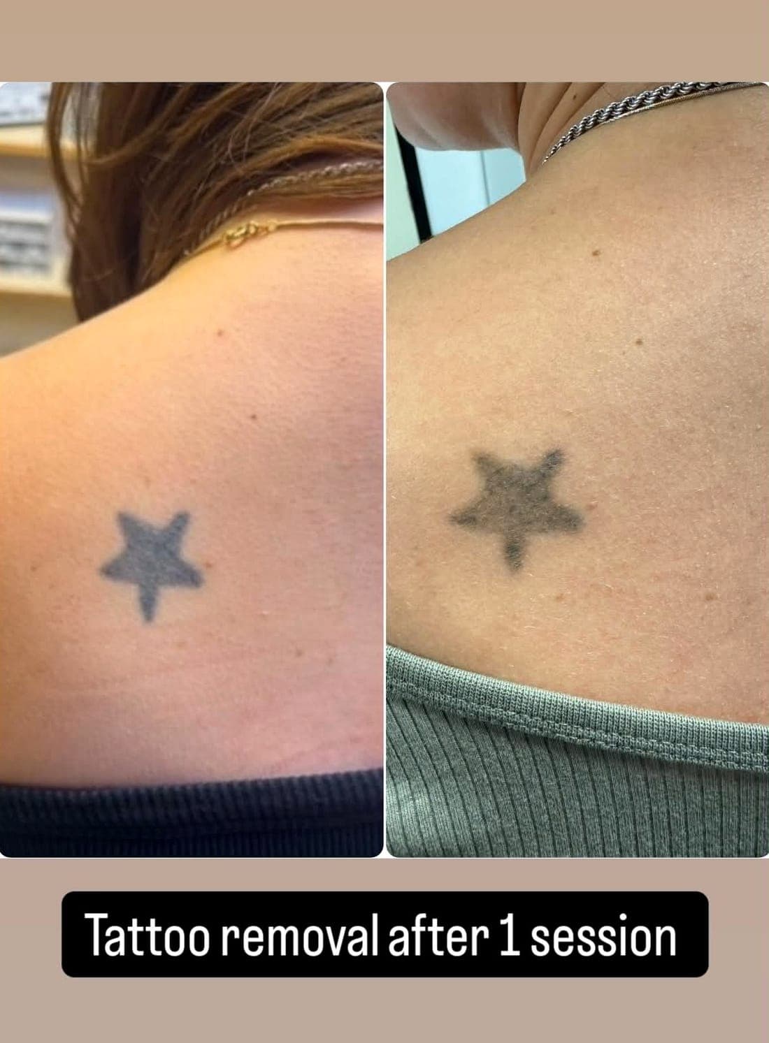 Laser Tattoo Removal — example 3