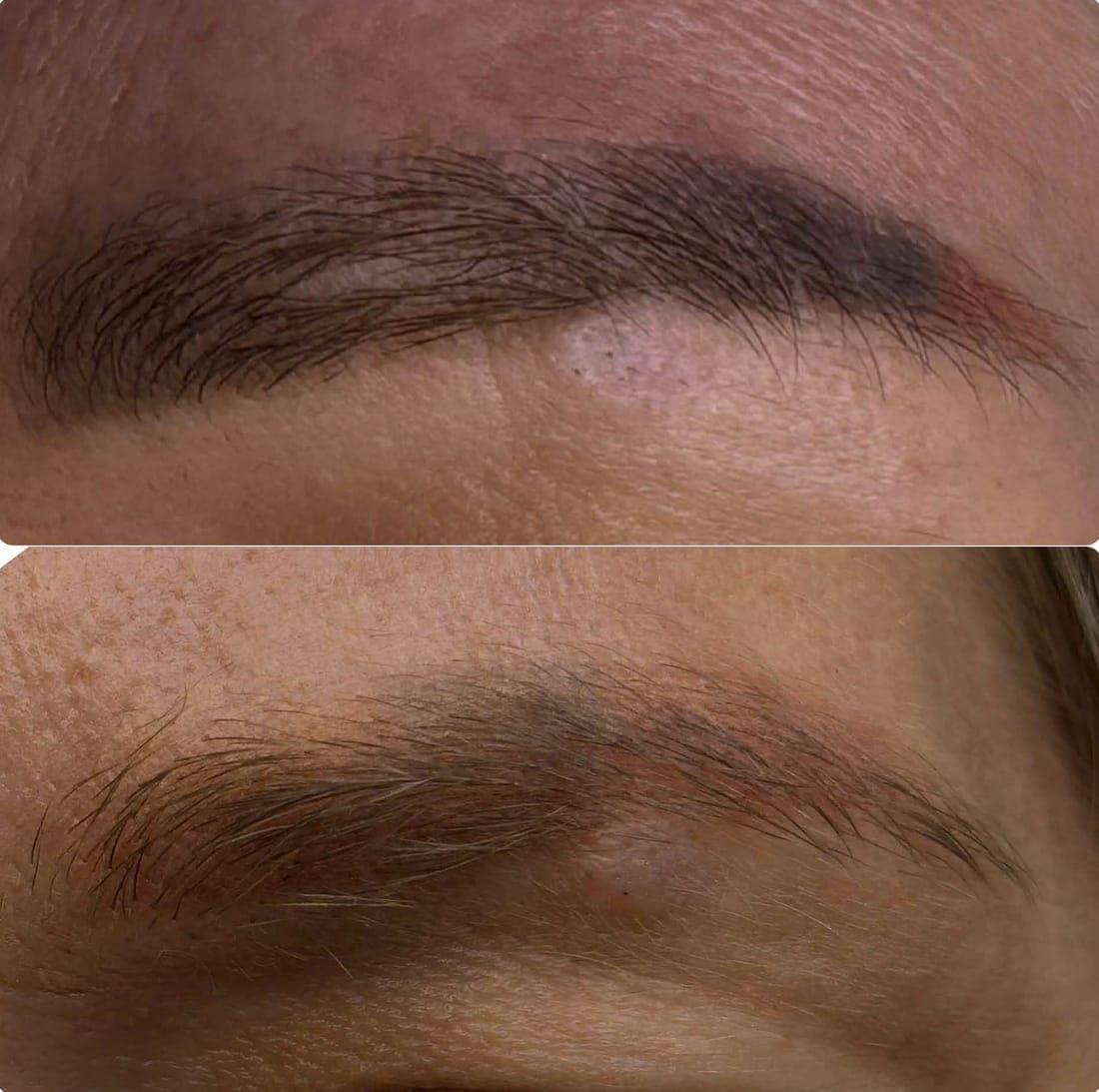 Laser Tattoo Removal — example 4
