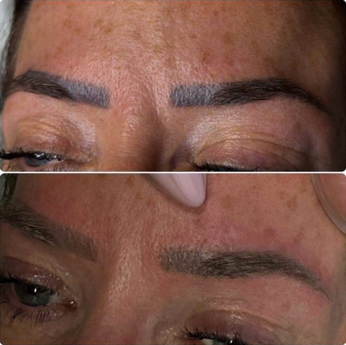 Laser Tattoo Removal — example 5