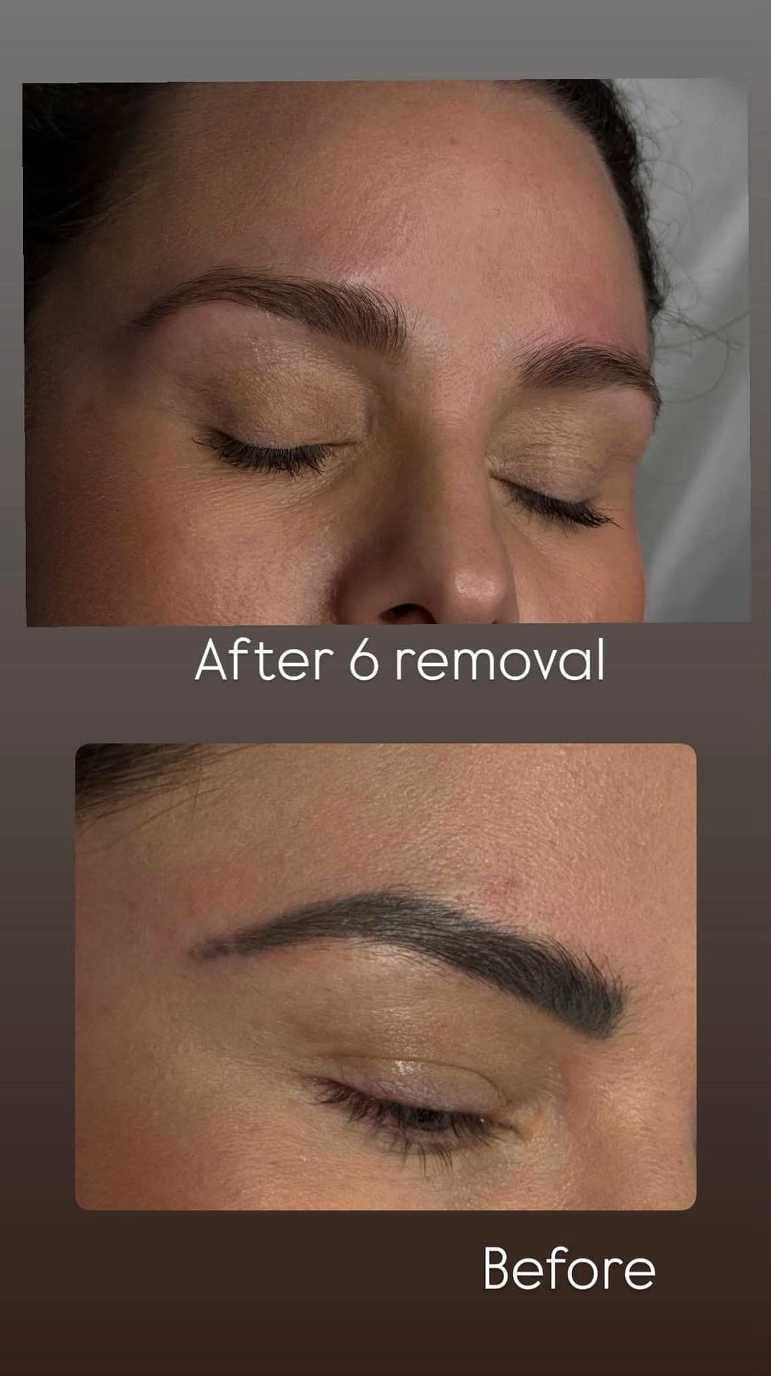 Laser Tattoo Removal — example 7