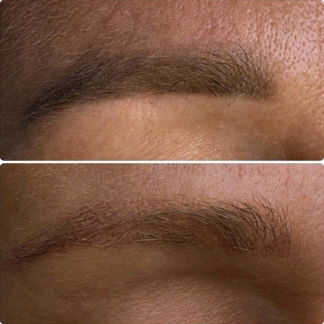Laser Tattoo Removal — example 8